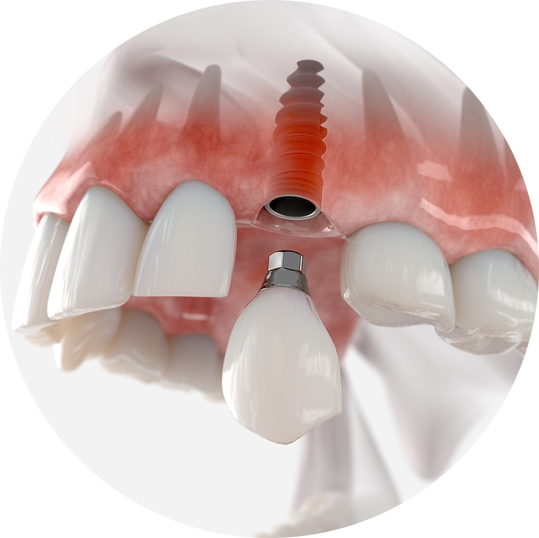 drawn illustration of dental implants
