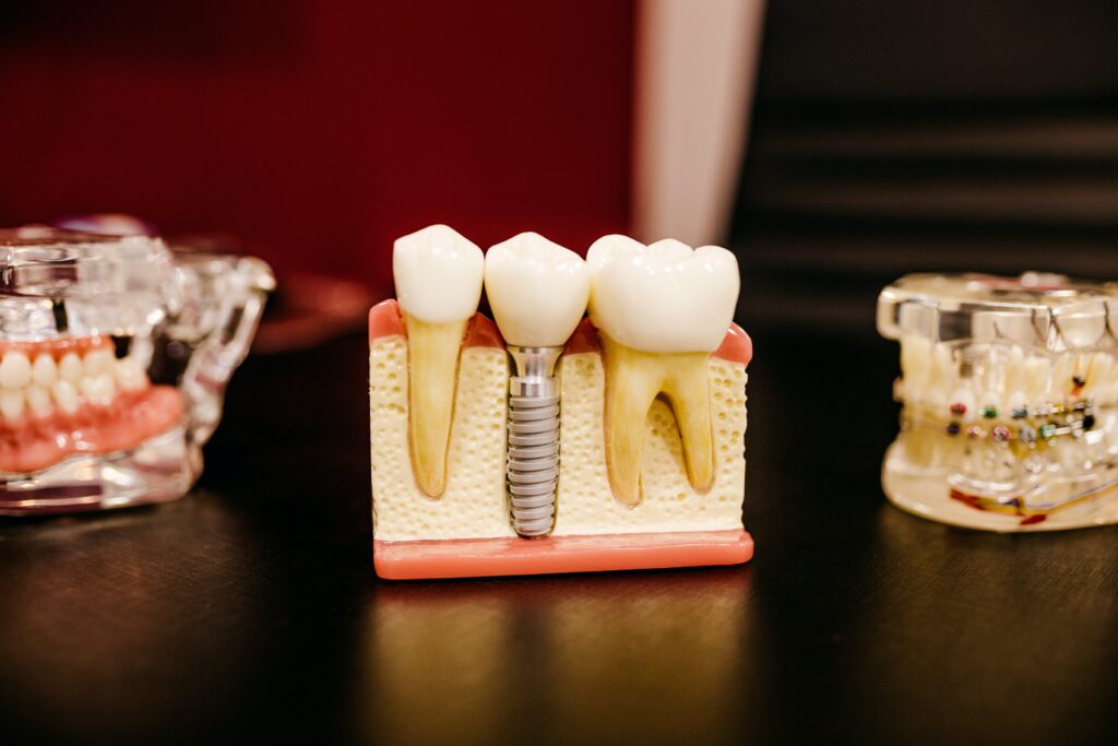 Dental implant example
