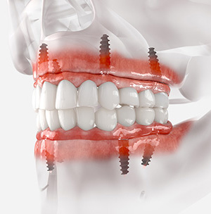 illustration of full mouth restoration